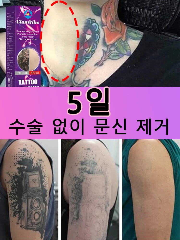 Permanent Pigmentation and Makeup Tattoo Removal
